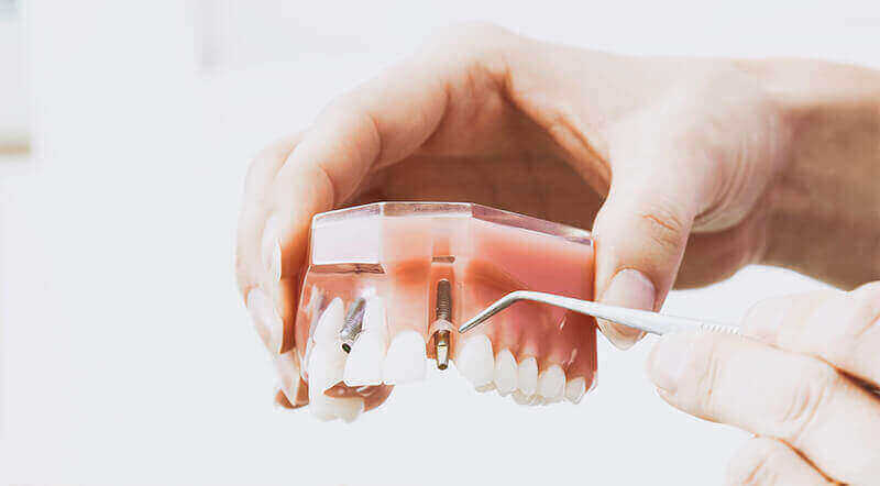 Dental Implants Kemptville