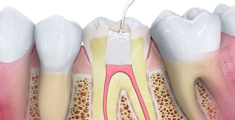 Root Canal Treatment Kemptville