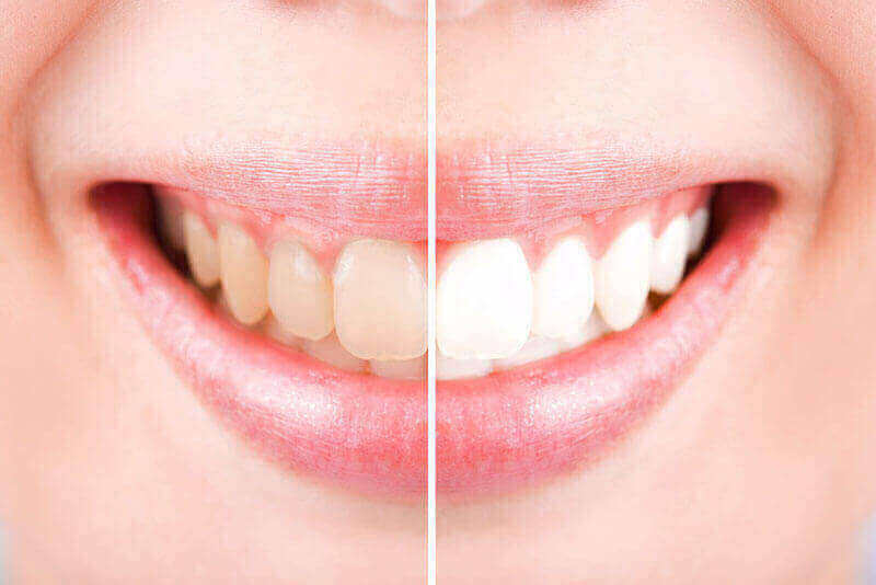 Teeth Whitening Kemptville